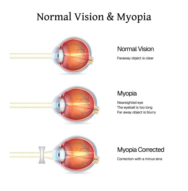 Myopia Graphic, explains how Myopia work